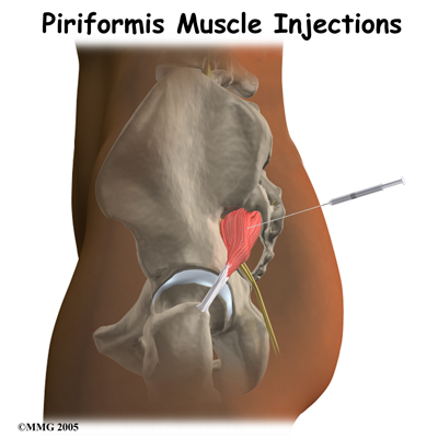 Piriformis Syndrom - Explained: Pittsburgh Physical Medicine and